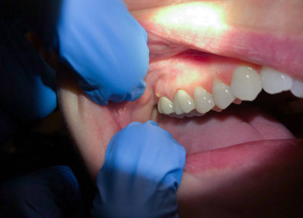 Best Emergency Care for Gum Disease in Oskaloosa, IA